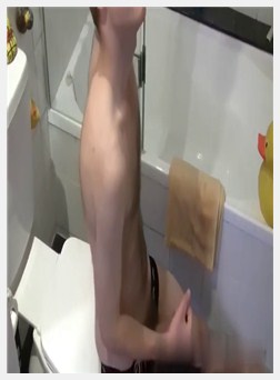 多毛老太小伙, 多毛骨瘦如柴老太太